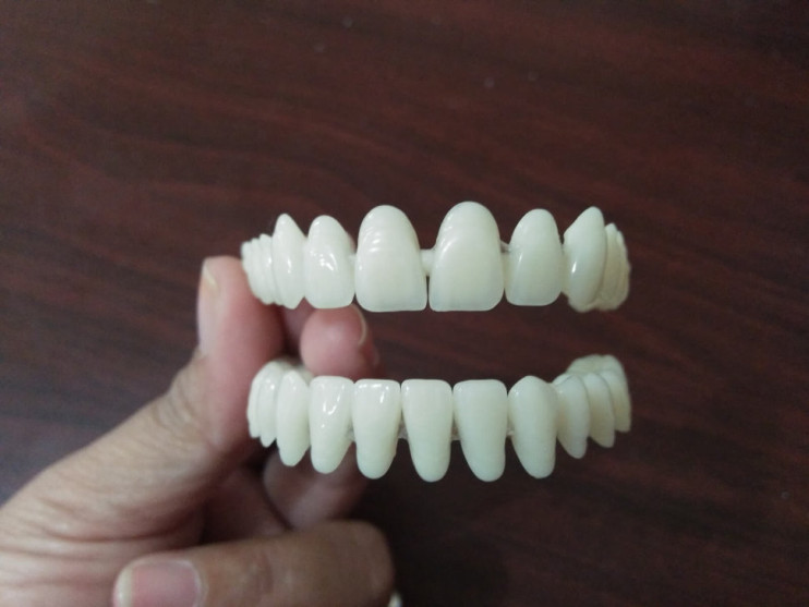 TruSmile Veneers в Санкт-Петербурге